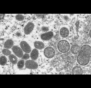 Electron micrograph of monkeypox virus particles isolated in 2003 in the United States from human samples (left, mature, oval viruses; right, immature, round viruses). Cynthia S. Goldsmith, Russell Regner / CDC / AP