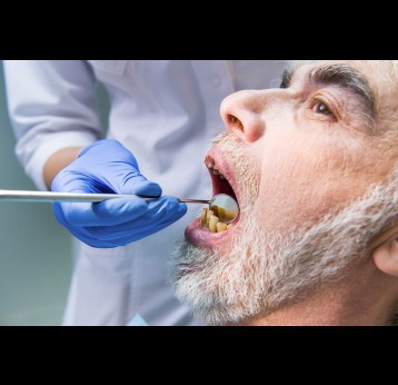 Old man with bad teeth with a hand holding mouth mirror.