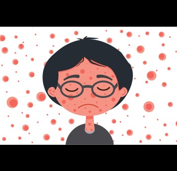 Illustration of a boy without immunity who is ill with measles.
