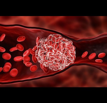 Blood clot blocking the red blood cells stream within an artery or a vein 3D rendering illustration.