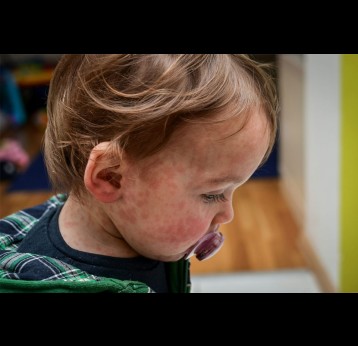 Canada eliminated measles in 1998 but had a major outbreak in 2025. Credit: jure/iStock via Getty Images Plus