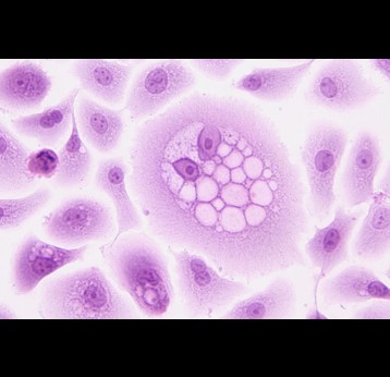 HPV-16 E5 Oncoprotein under the microscope. Credit: National Cancer Institute