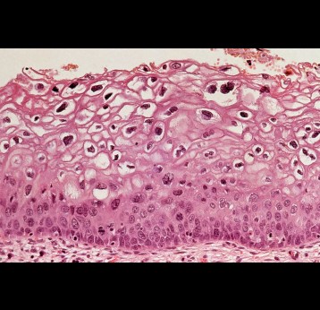 Cervix: human papillomavirus infection. Credit: Wellcome Collection.