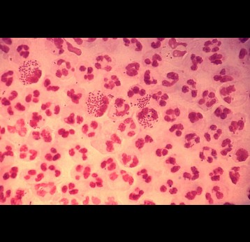 Photomicrograph revealing the histopathology in an acute case of gonococcal urethritis using Gram-stain technique. Credit: CDC/ Joe Millar. 