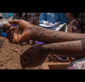 Mpox patient. Credit: Ministry of Health Zambia
