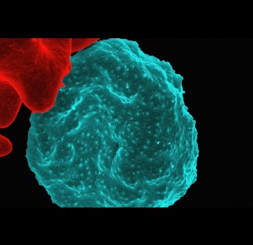 Red Blood Cell Infected with Malaria Parasites Colorized scanning electron micrograph of red blood cell infected with malaria parasites (teal). Credit: NIAID