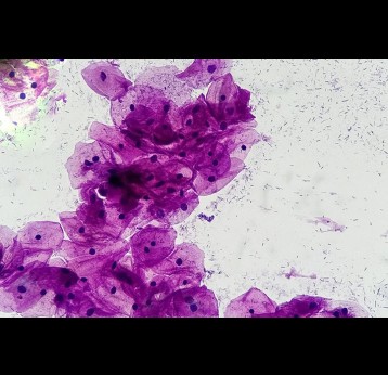 View through microscope of healthy human cervical cells; cells are stained pink against a flecked background. Credit: © 2026 Harvard Health Publishing