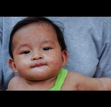 Measles causes a distinctive rash that usually begins on the face before spreading across the body. Falling vaccination rates have contributed to its resurgence. phichet chaiyabin/Shutterstock