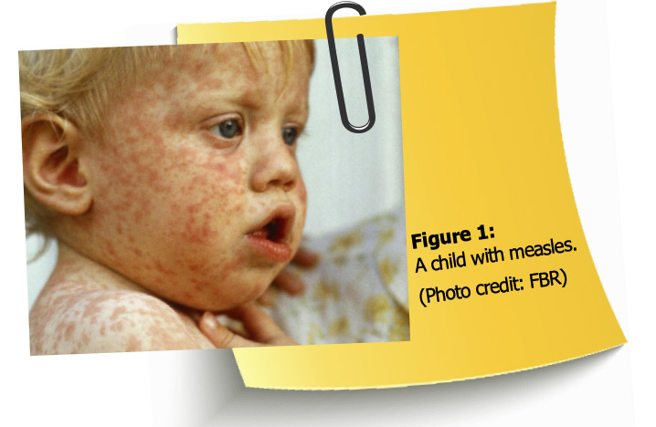 Figure 1: A child with measles. (Photo credit: FBR)