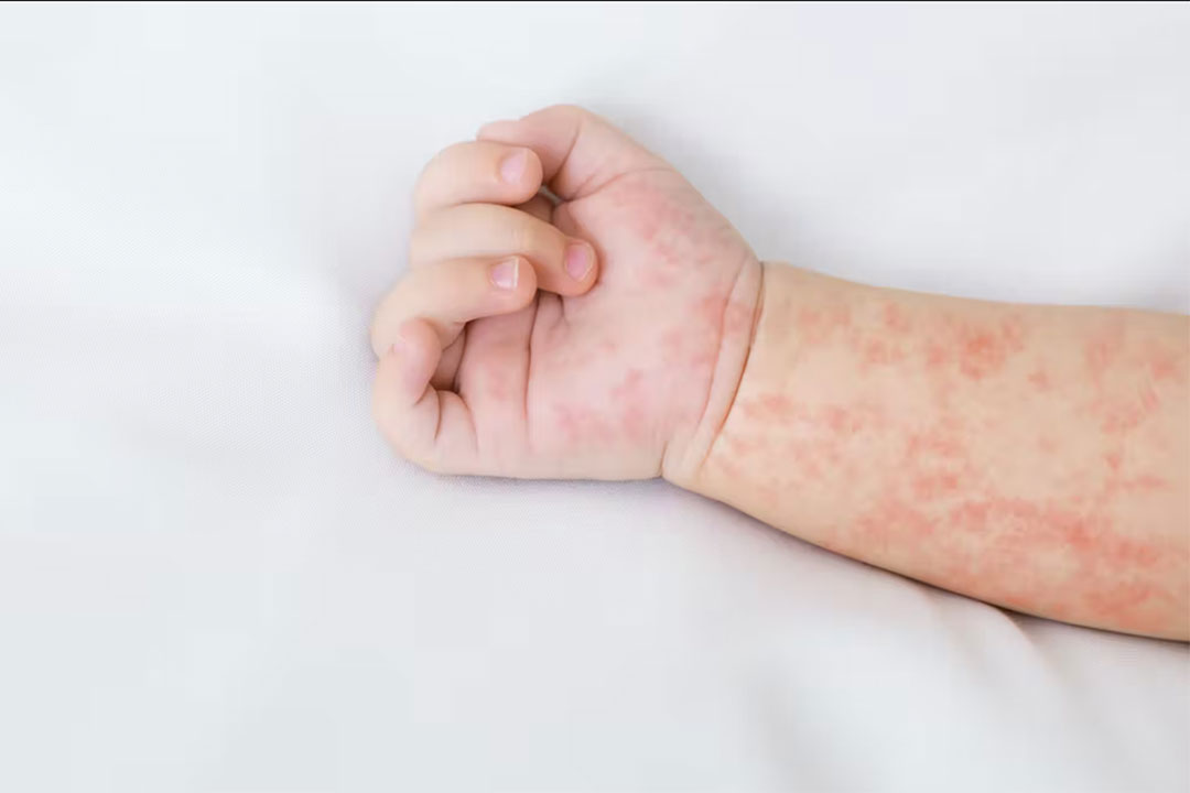 Les taches caractéristiques de la rougeole apparaissent 3 à 4 jours après l'infection et vont couvrir tout le corps. Shutterstock / Prostock-studio