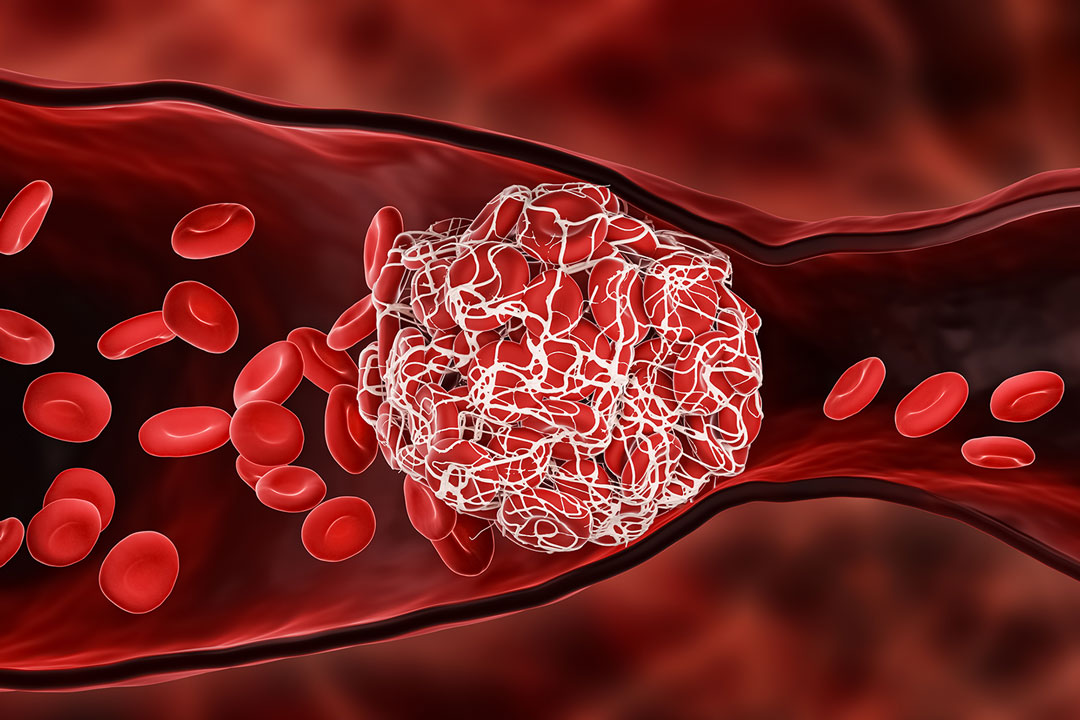 Blood clot blocking the red blood cells stream within an artery or a vein 3D rendering illustration.