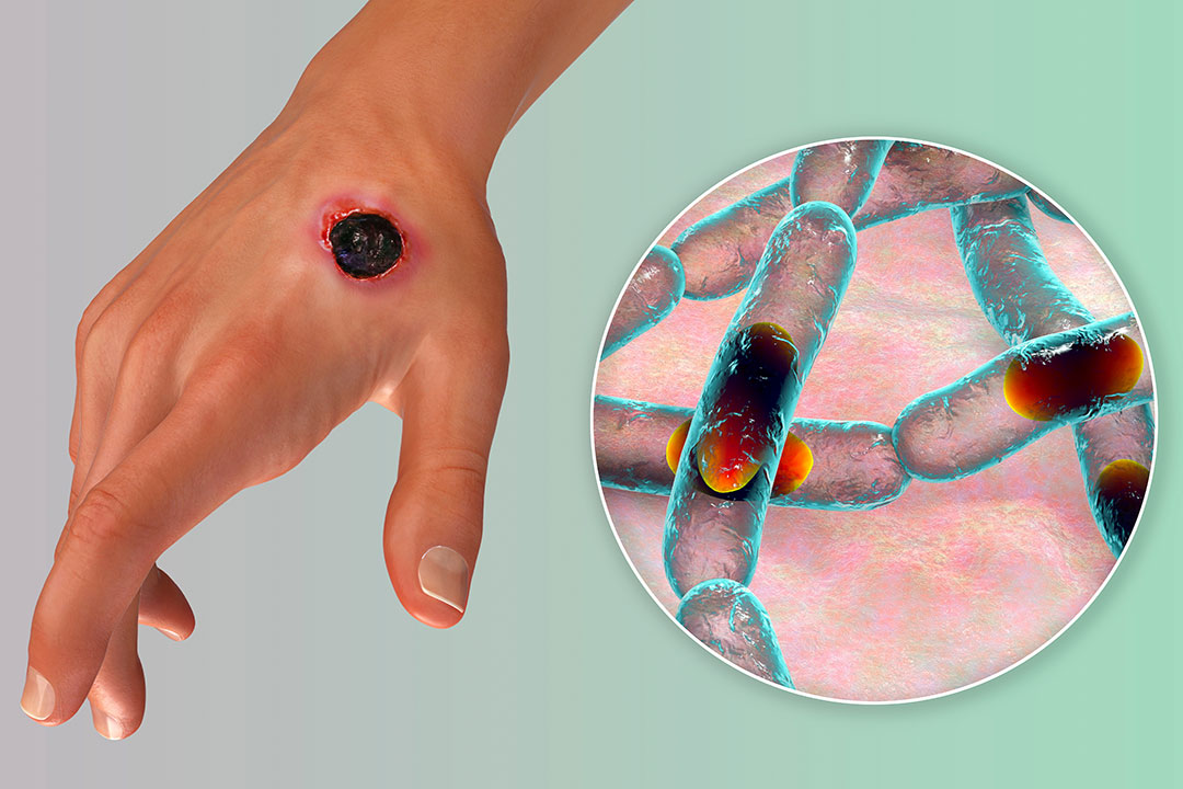 Cutaneous anthrax, the most common form of anthrax. 3D illustration.