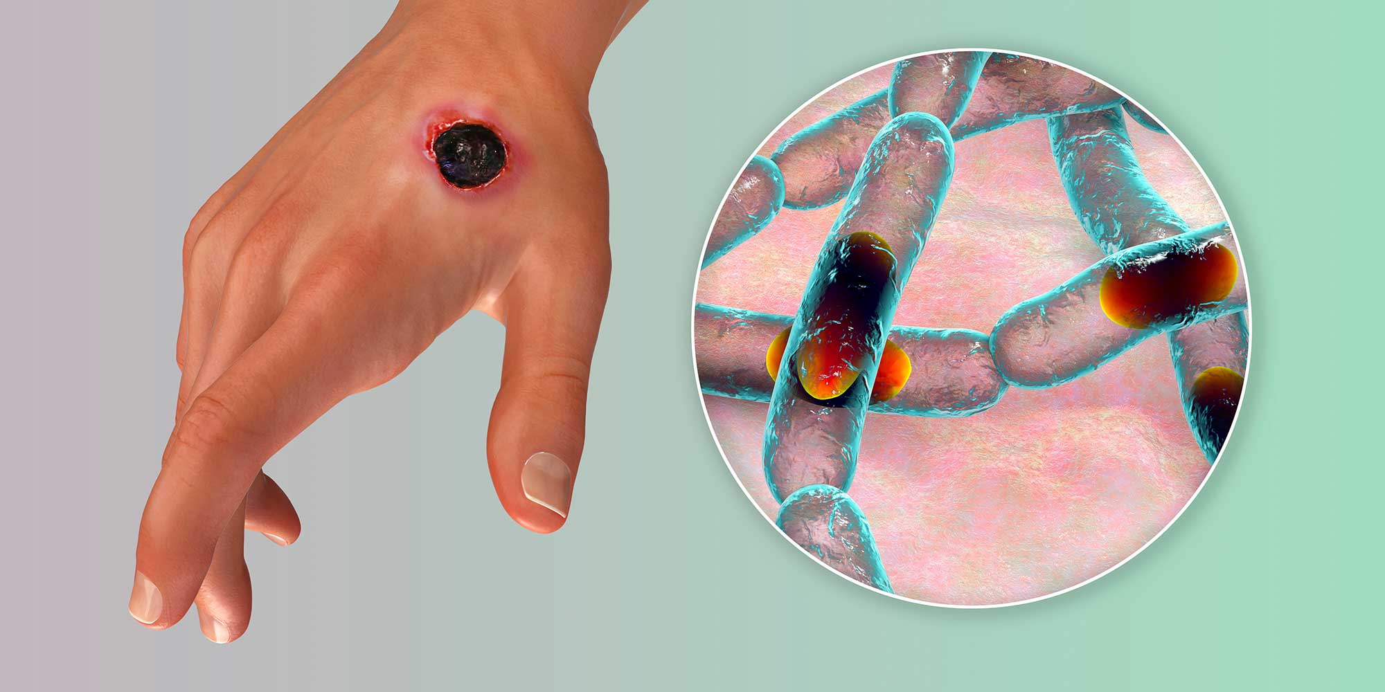 Cutaneous anthrax, the most common form of anthrax. 3D illustration.