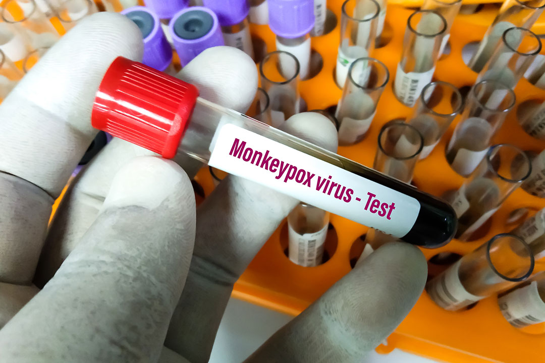 Blood sample tube for Monkeypox virus test.