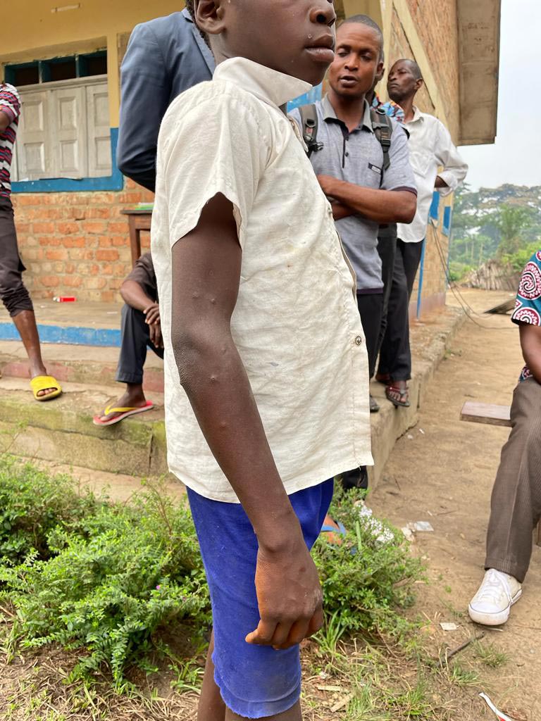 Enfant présentant des signes de la variole du singe dans la zone de santé de Kibombo. Crédit : Patrick Kahondwa