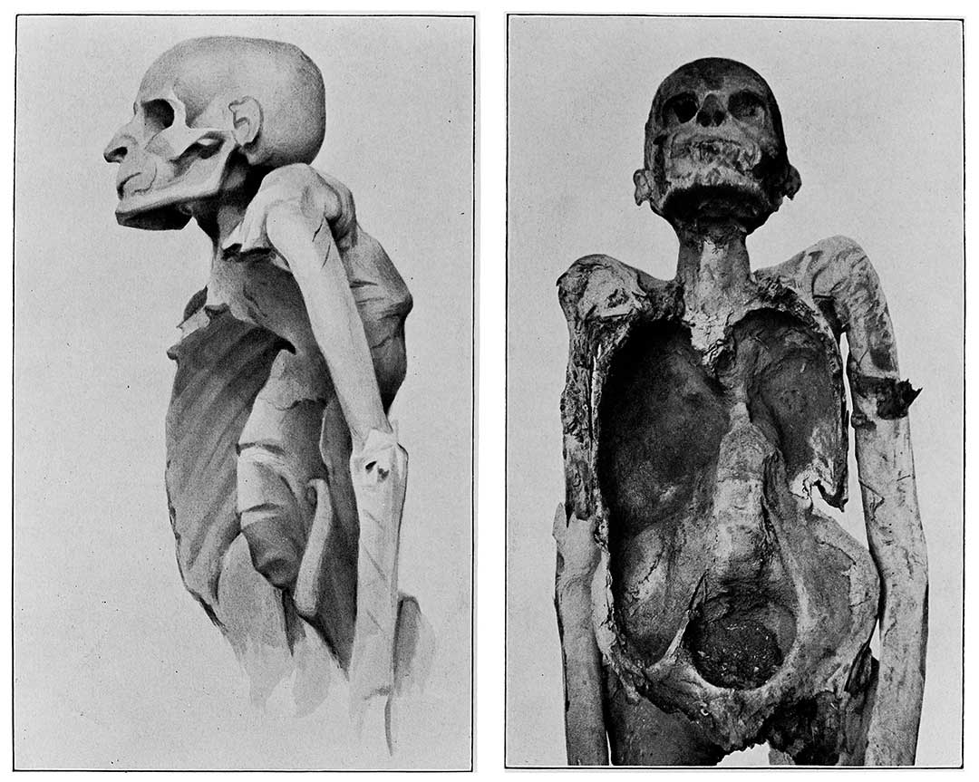 Tuberculosis of the spine in an Egyptian mummy of the 21st dynasty, 1069-945 BCE. Photograph from 1910. Credit: Wellcome Collection. Attribution 4.0 International (CC BY 4.0)