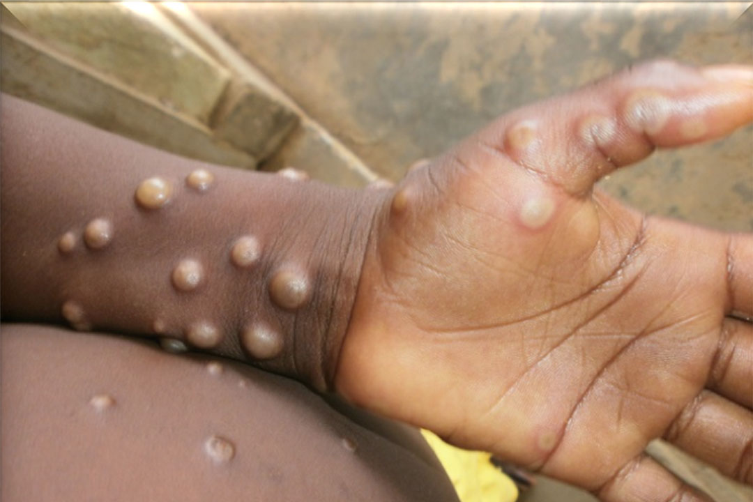 Mpox symptoms on a forearm and hand. Credit: Nigeria Centre for Disease Control