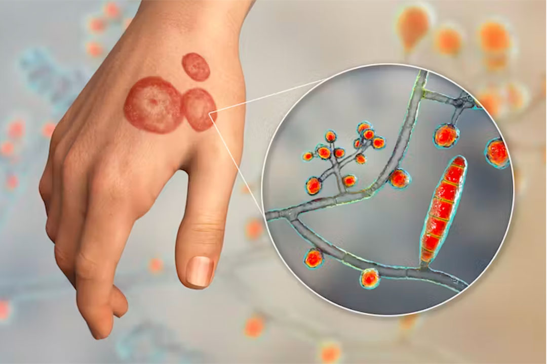 Ringworm is often easy to spot with its characteristic red rings on the skin. Credit: Kateryna Kon/Science Photo Library via Getty Images