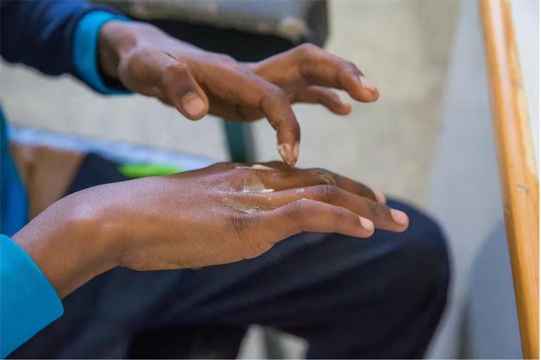 Scabies and other skin diseases are still common in Togo. Credit: Wikimedia Commons/Flickr