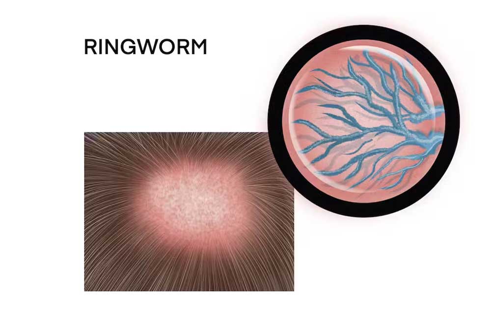 Ringworm commonly affects the scalp area and can cause hair loss. Credit: Viktoriya Kabanova/iStock via Getty Images Plus