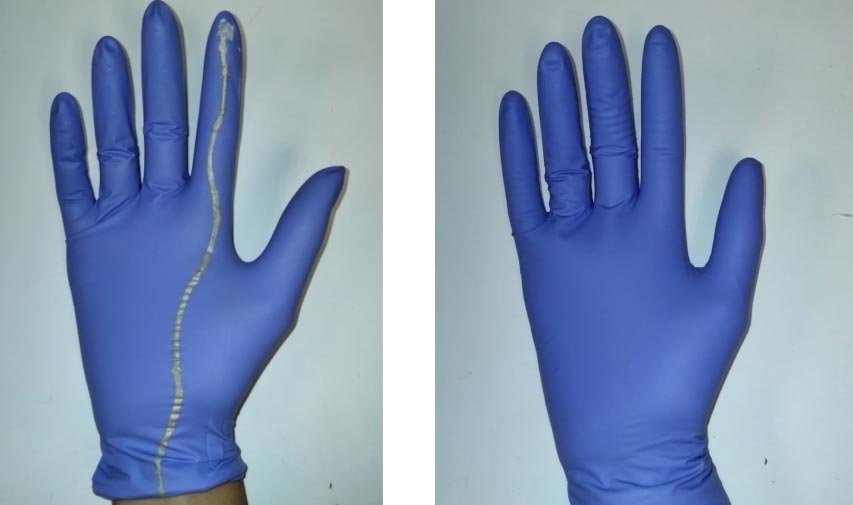 The low-cost smart glove has nanocomposite sensors on the fingertips to help detect the position of the fetus. Credit: Wellcome/EPSRC Centre for Interventional and Surgical Sciences (WEISS)