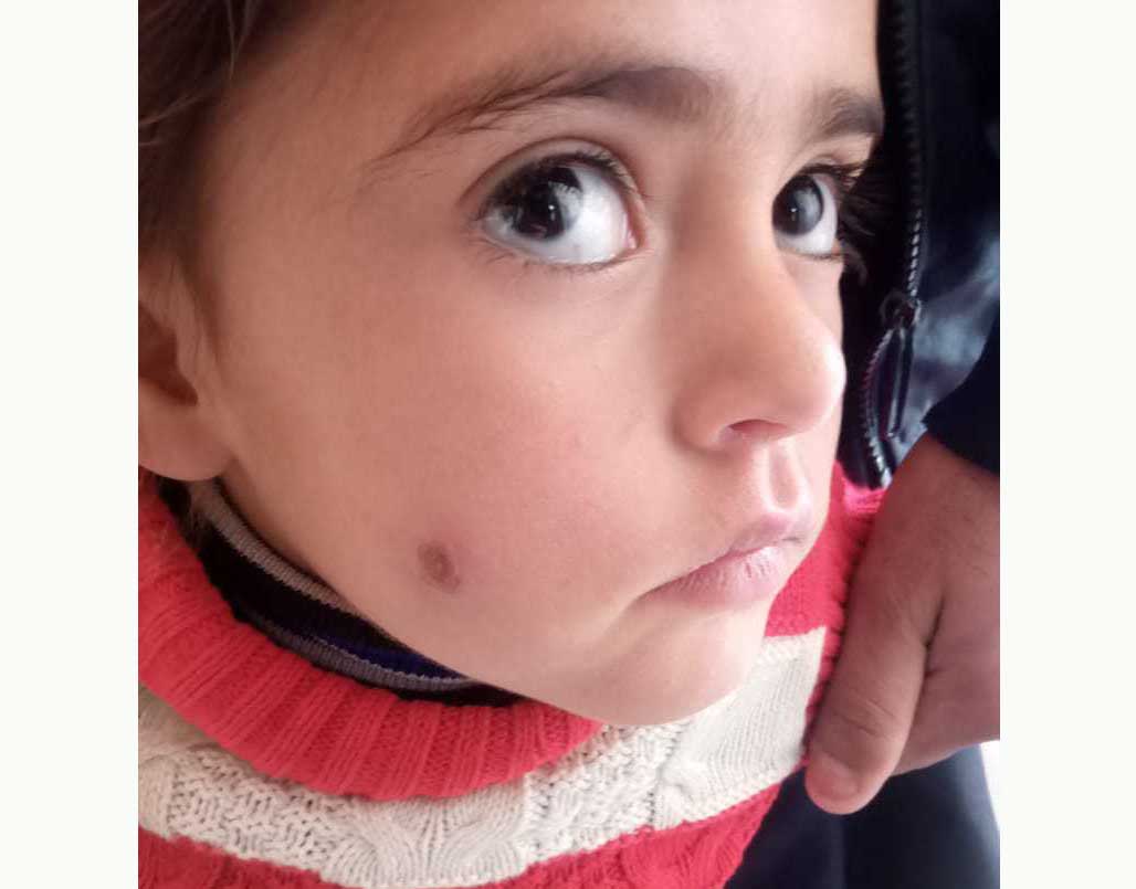A child with a scar on his face due to infection of cutaneous leishminiasis is being checked at a hospital. 