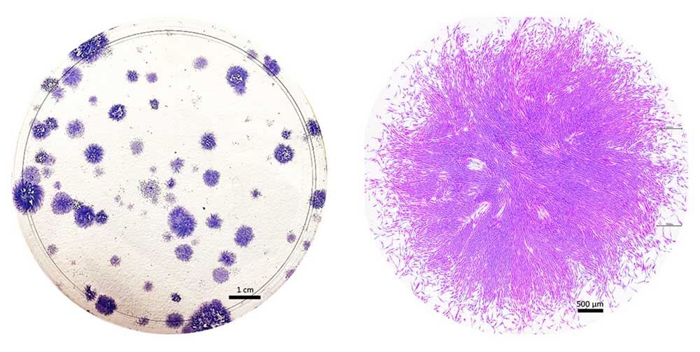 These purple blobs are clones of the stem cells that Caroline Gargett and colleagues identified in menstrual fluid. Each cluster began as a single cell. On the right, a close-up view of one blob, magnified at least 20 times, reveals the tightly packed cells’ whiskery, spindled shapes.  CREDIT: K. SCHWAB, C. TAN AND C. GARGETT, THE RITCHIE CENTRE, HUDSON INSTITUTE OF MEDICAL RESEARCH AND MONASH UNIVERSITY DEPARTMENT OF OBSTETRICS AND GYNAECOLOGY, MELBOURNE AUSTRALIA