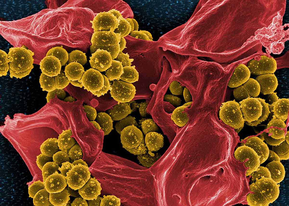 Antibiotic resistance is a growing problem. This photo shows methicillin-resistant Staphylococcus aureus (yellow) — one of the most serious resistant pathogens — and a dead human white blood cell (red). Researchers have had some success in reversing antibiotic resistance by treating infected patients with particular bacteriophages. CREDIT: NATIONAL INSTITUTE OF ALLERGY AND INFECTIOUS DISEASES (NIAID) / NIH