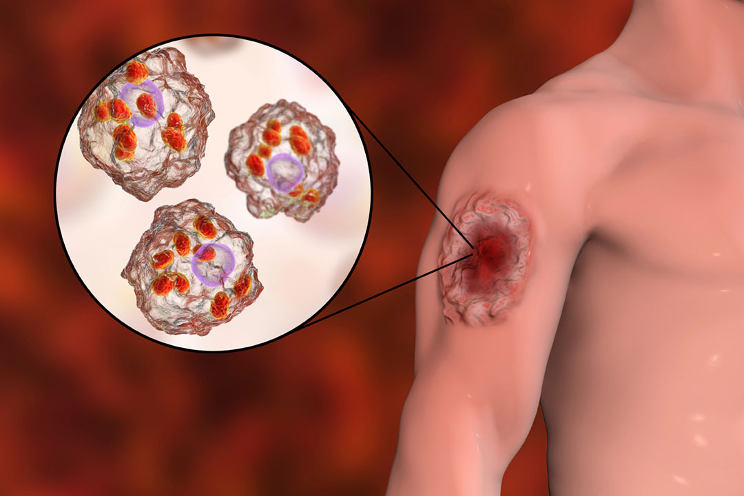 Cutaneous leishmaniasis is a parasitic disease transmitted by sandflies, causing painful lesions on the skin