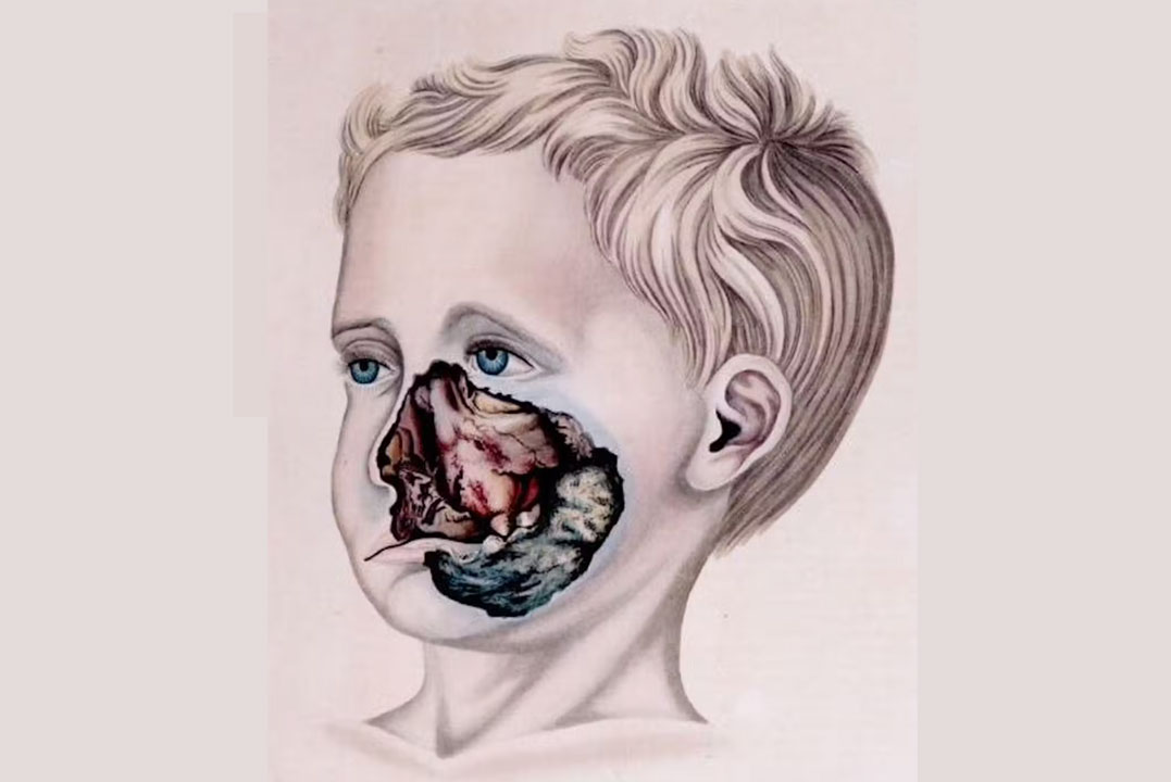 A medical artist’s drawing of a boy with noma. Credit: Robert Froriep/Wikimedia Commons