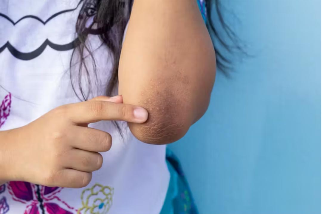 Acanthosis nigricans can cause skin to become thickened and velveteen to the touch. Credit: TuktaBaby/ Shutterstock