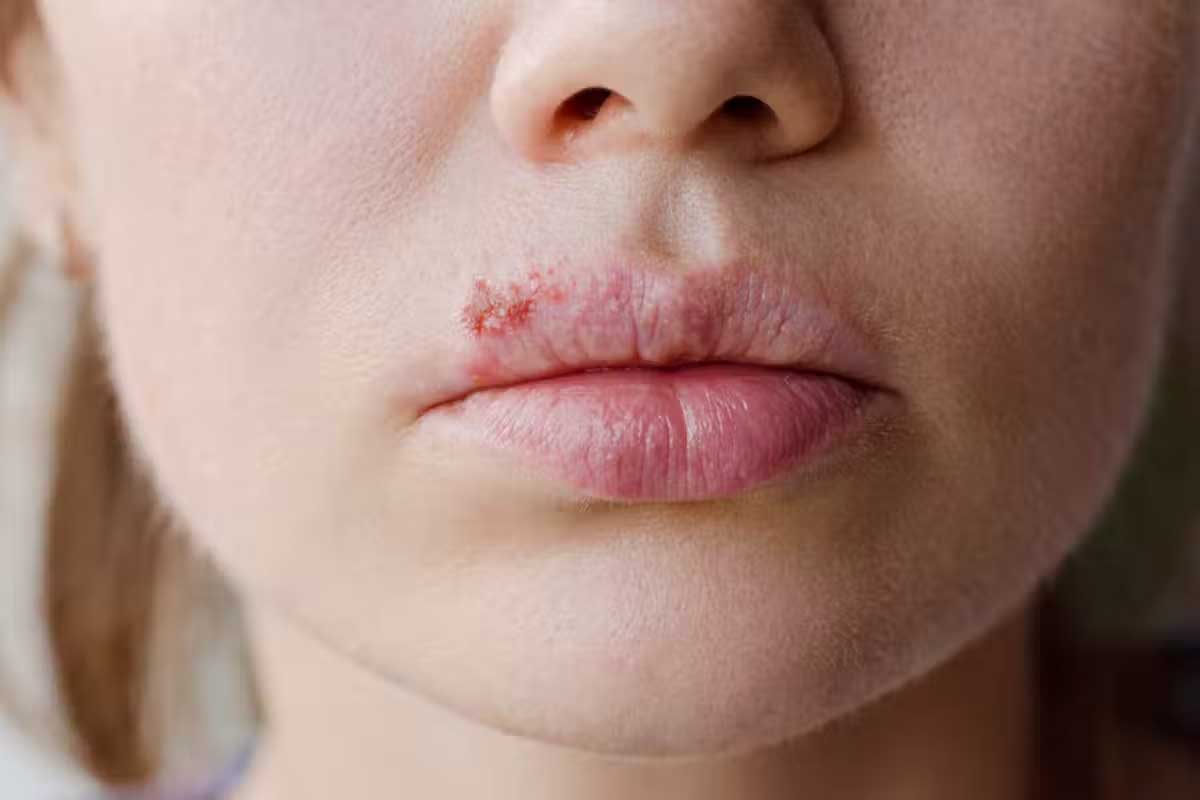 Herpes hides out in our body from childhood – occasionally erupting as cold sores. Domaskina/Shutterstock