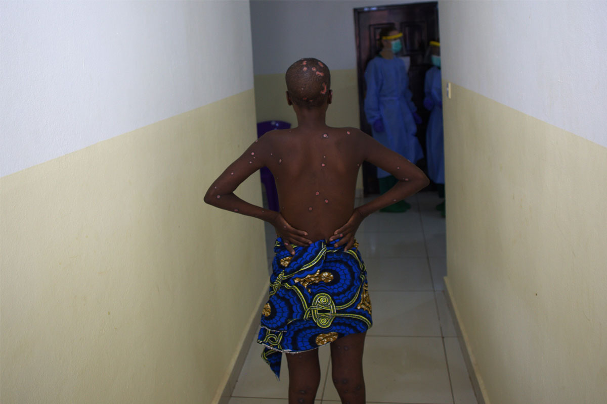 An mpox patient at a treatment centre in Freetown. Credit: Saidu Bah