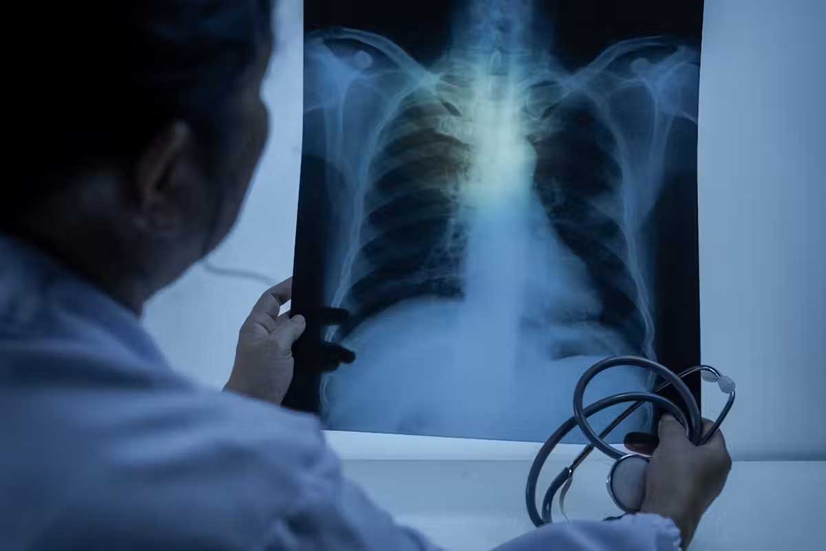 Lungs infected with pneumonia will have solid white areas on an X-ray. Komsan Loonprom/Shutterstock