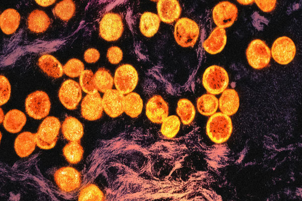 A micrograph of mpox virus particles (gold and orange) found within an infected cell (purple). Credit: National Institute of Allergy and Infectious Diseases (NIAID)