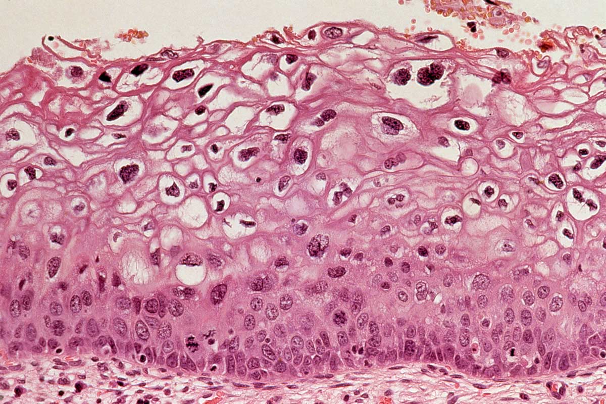 Cervix: human papillomavirus infection. Credit: Wellcome Collection.