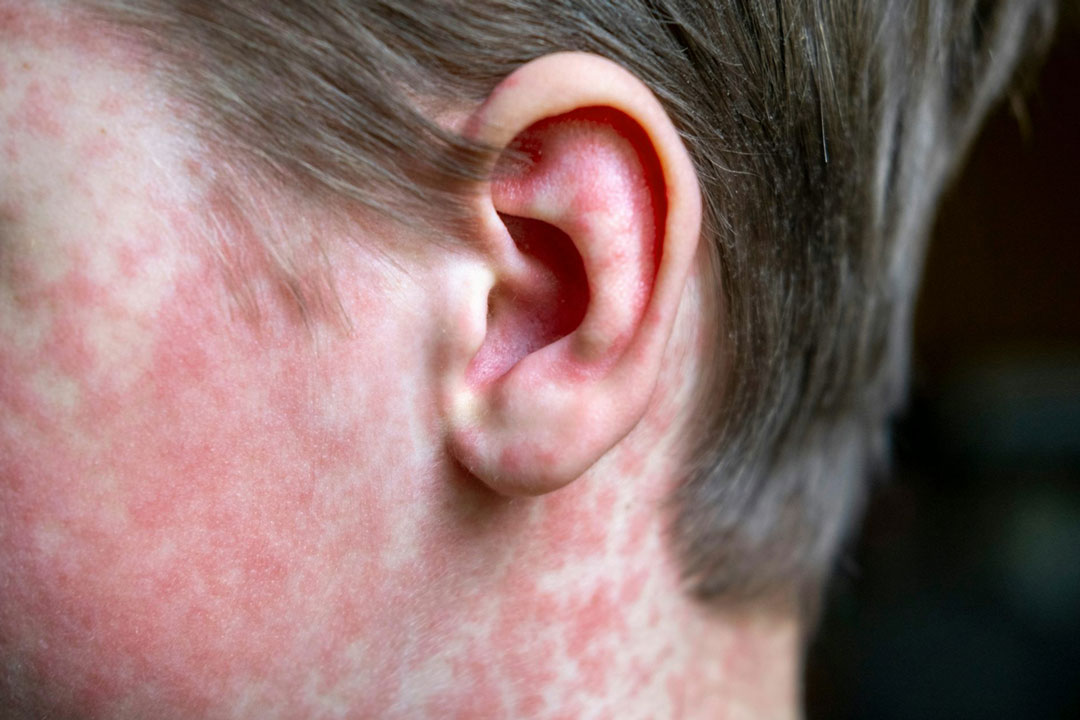 A child with measles. Credit: Natalya Maisheva/Shutterstock.com