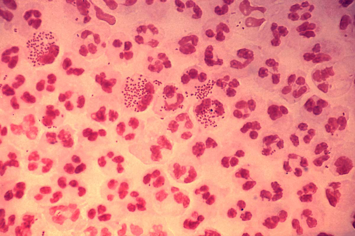 Photomicrograph revealing the histopathology in an acute case of gonococcal urethritis using Gram-stain technique. Credit: CDC/ Joe Millar. 