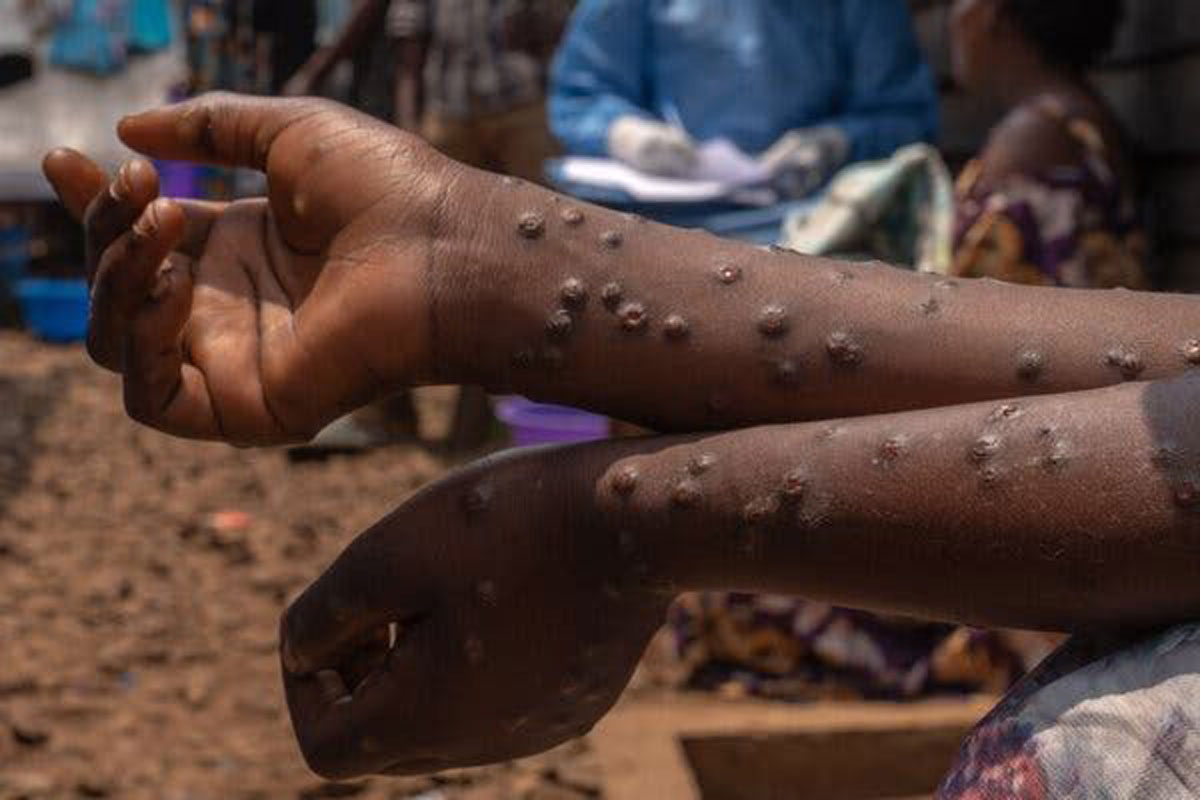 Mpox patient. Credit: Ministry of Health Zambia