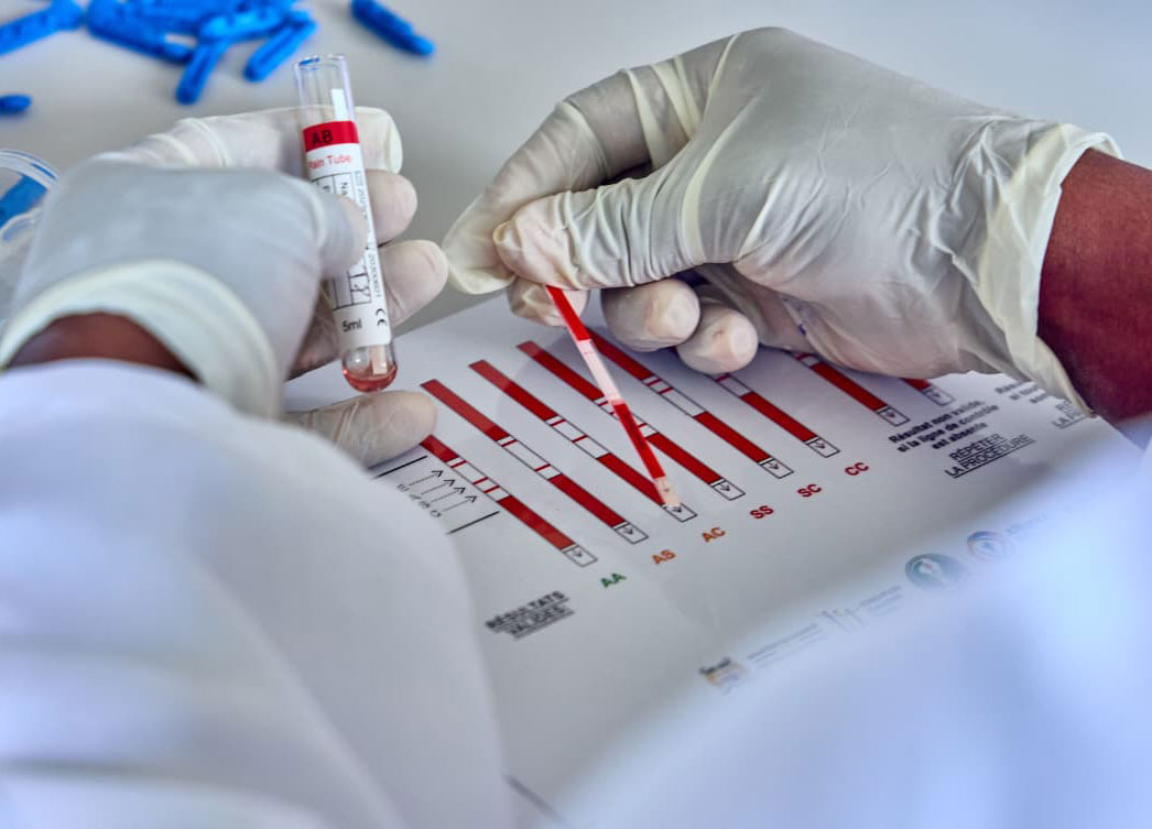 A health worker assesses the result of a blood screening for sickle-cell trait. "A" stands for a normal haemoglobin gene, whereas "S" stands for sickle-cell gene, and "C" stands for a different mutation of the haemoglobin gene. Credit: Programme national de lutte contre les maladies non transmissibles