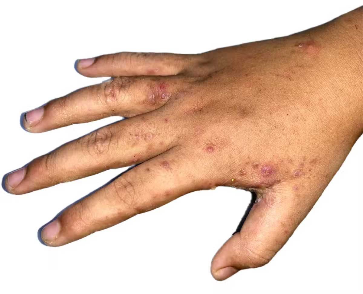 Scabies can cause intense itching. Zay Nyi Nyi/Shutterstock.com