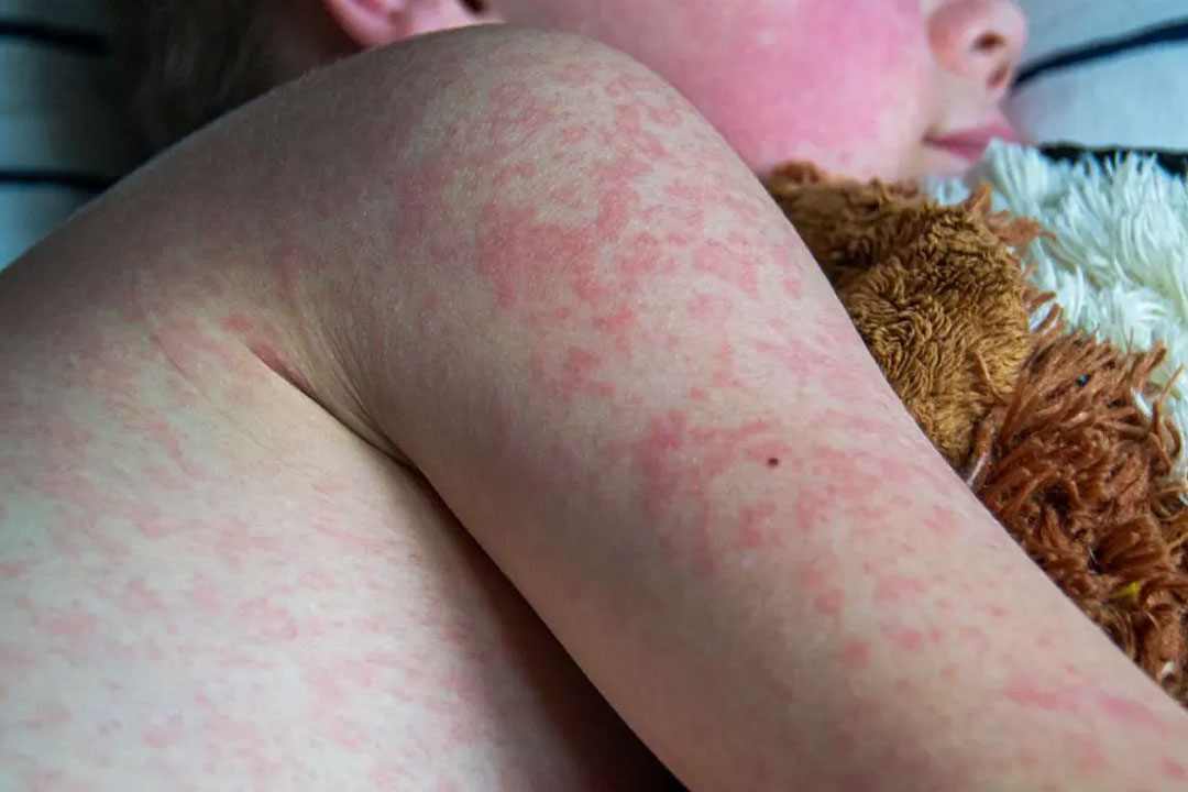 Measles cases in the Americas have almost tripled already in 2026 compared to the number recorded for the whole of 2025, as vaccine coverage declines. Copyright: Enlace Latino NC CC BY-ND 4.0 Deed