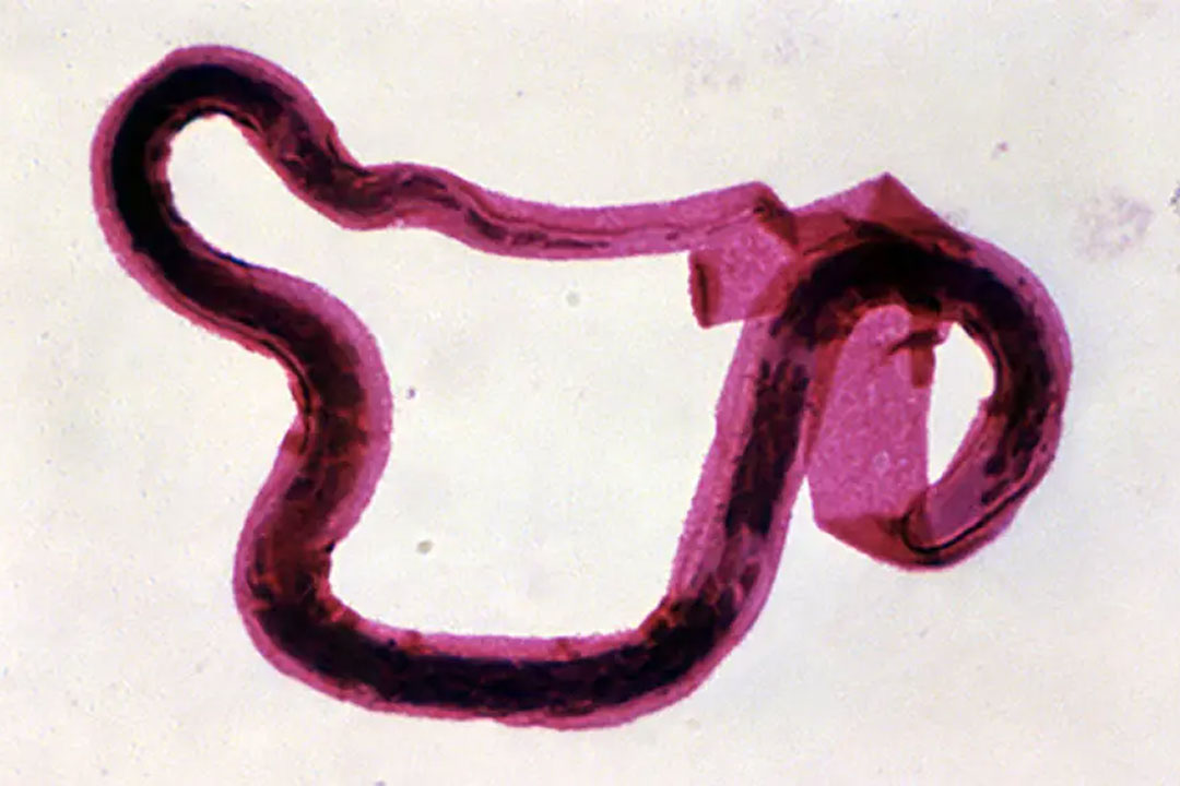 A filarial worm, one of the causative agents of Elephantiasis (lymphatic filariasis). Researchers in Tanzania say eliminating the disease reduced susceptibility to HIV infection. Copyright: CDC