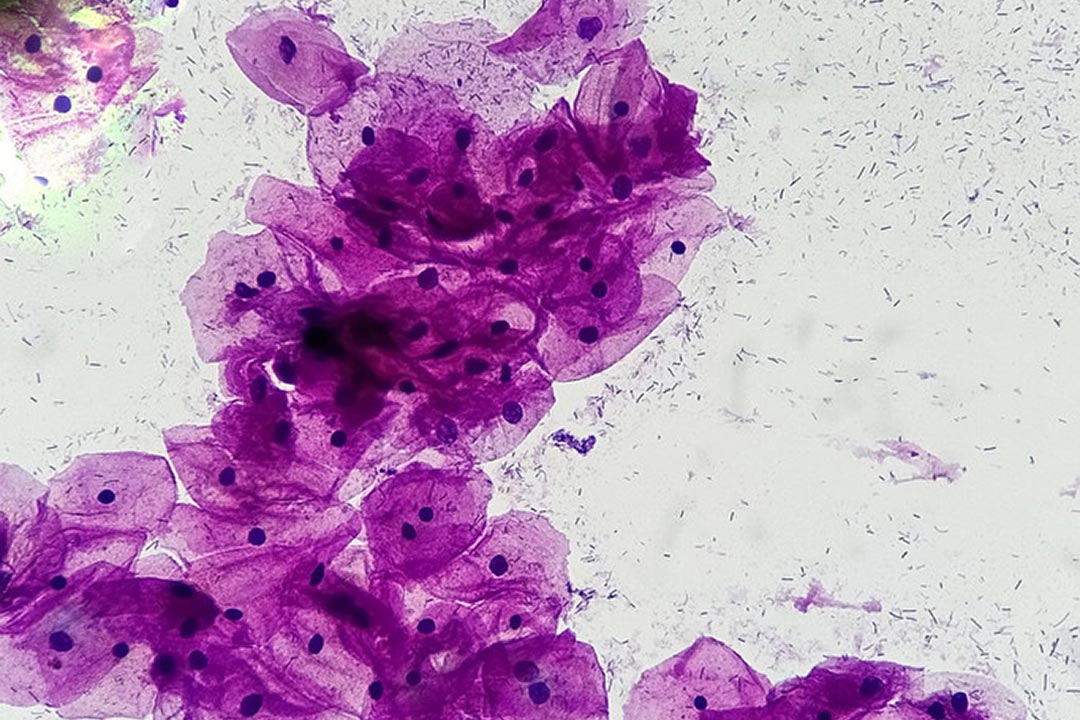 View through microscope of healthy human cervical cells; cells are stained pink against a flecked background. Credit: © 2026 Harvard Health Publishing