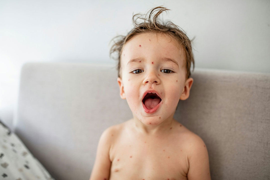 Chickenpox can leave scars. Dragana Gordic/Shutterstock.com