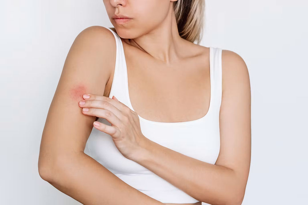 Your reaction to mosquito bites can even change over time. Marina Demeshko/ Shutterstock