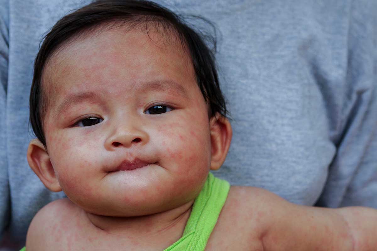 Measles causes a distinctive rash that usually begins on the face before spreading across the body. Falling vaccination rates have contributed to its resurgence. phichet chaiyabin/Shutterstock